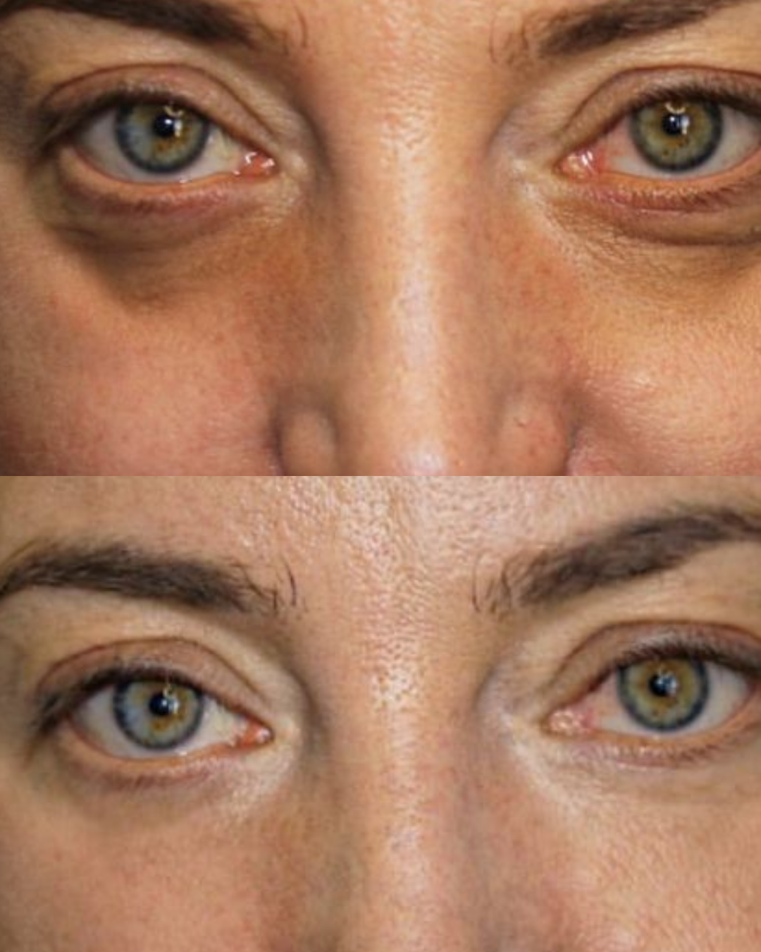 UnderGlow® 2-in-1 RLT + EMS Device